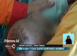 Kelainan Gen, Kepala Bayi Fatimah Terus Membesar