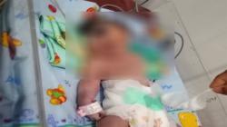 Bayi Perempuan Lahir Bermata Satu Tanpa Hidung Gegerkan Warga Madina