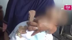 Balita 4 Tahun Alami Penyakit Langka, Sekujur Tubuhnya Kaku seperti Kayu