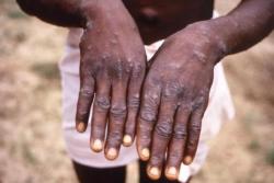 Apa Kabar Pasien Pertama Monkeypox di Indonesia? Kemenkes Beberkan Kondisinya