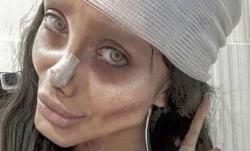 Operasi Plastik demi Mirip Angelina Jolie, Selebgram Iran Malah Ditangkap