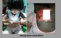 Kisah Haru Ratna Maya Bocah Penderita Kelainan Kulit asal Rembang