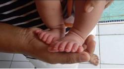 Viral Kakak Adik Galuh dan Galih asal Indramayu Punya 12 Jari Tangan dan Kaki<