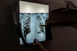 Ternyata Ini Penyebab Kasus Tuberkulosis di Indonesia Menurun Drastis Selama Pandemi   