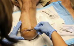 Duh, Dokter Salah Amputasi, Harusnya Kiri, Justru Kaki Kanan Pasien yang Dipotong<