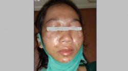 Guru TK Cantik di OKU Timur Disiram Cuka Para, Wajah Rusak dan Mata Buta