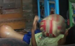 Berawal dari Jatuh, Kaki Bocah Ini Bengkak Sebesar Melon hingga Harus Diamputasi
