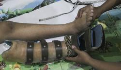 Pembuatan Kaki Palsu di Bekasi, Dijual hingga Puluhan Juta Rupiah