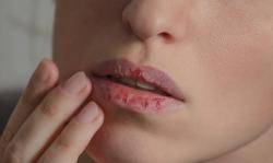 Cara Mengatasi Bibir Pecah saat Puasa, Nomor 3 Sering Tak Disadari Jadi Penyebabnya!