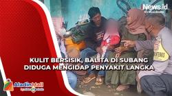Kulit Bersisik, Balita di Subang Diduga Mengidap Penyakit Langka<