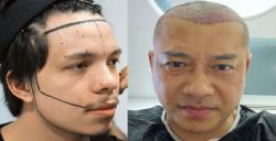 Transplantasi Rambut Jadi Tren hingga Dilakukan Selebriti Tanah Air, Ternyata Ini Alasannya