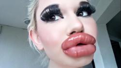 Perempuan Ini Punya Bibir Terbesar di Dunia, Begini Tampilannya