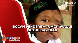 Bocah Penderita Tumor Wajah di Pandeglang Butuh Bantuan