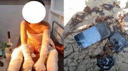 HP Meledak saat Dimainkan sambil Dicas, Bocah di Sukabumi Luka Bakar Sekujur Tubuh 
