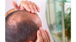 5 Cara Menumbuhkan Rambut di Jidat, Cocok Buat yang Mengalami Kebotakan