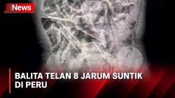 Balita Menelan 8 Jarum Suntik di Peru