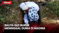 Balita Gizi Buruk di Madina Meninggal Dunia, Tak Ada Biaya Berobat<