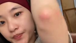 Viral Kisah Perempuan Terkena Ringworm usai Pakai Matras Gym, Imbau Netizen Berhati-hati