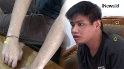 Kulit Sekujur Tubuh Pria di Parepare Ini Melepuh usai Minum Obat dari Puskesmas