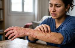 Satu Kena Skabies Semua Orang di Rumah Wajib Diobati! Dokter Ungkap Fakta Ini