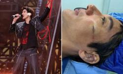 Mengerikan! Penyanyi Wang Leehom Jatuh saat Konser, Terima 39 Jahitan di Wajah