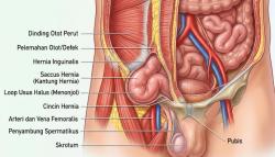 Benjolan di Lipat Paha Anak Bisa Jadi Hernia, Kenali Tandanya