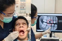 Gigi Berlubang Jangan Dibiarkan, Bisa Ganggu Makan dan Kemampuan Bicara