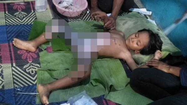 Bocah Bocah asal Lampung yang menderita luka bakar dan tak mampu berobat (Jimi Irawan/iNews)