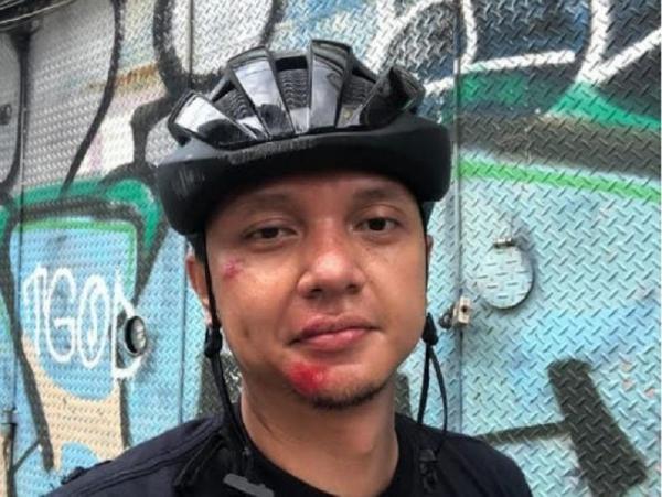 Vokalis barasuara, Iga Dada Yudhistira Massardi menujukkan luka saat jatuh dari sepeda.