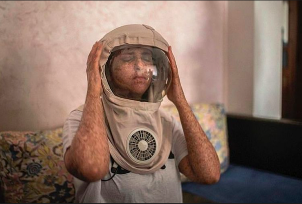 Screen Shot 2021 12 26 At 11 20 09 Fatima Ghazaoui, gadis asal Maroko yang mengidap kelainan genetik langka Xeroderma pigmentosum, harus memakai helm astronot tiap keluar rumah di siang hari.(DOK FATIMA GHAZAOUI via DAILY MAIL)