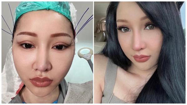 Lucinta Luna Artis operasi plastik di 2023. (foto: instagram)
