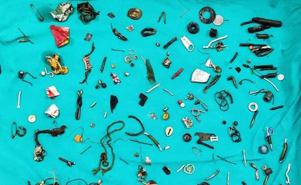 100 Barang Dalam Perut Pasien Barang-barang yang ditemukan dalam perut seorang pasien yang dibedah oleh tim dokter di sebuah RS di Kota Moga, Punjab, India. (Foto: Jam Press/Rare Shot News)