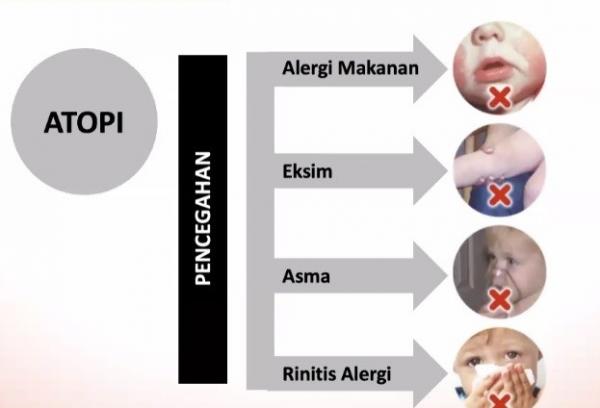 Alergi Susu Anak