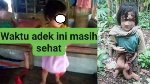 bocah perempuan nias selatan Foto kolase bocah NN saat kakinya masih normal dan bengkok atau patah diduga menjadi korban penganiayaan. (Foto: Ist)