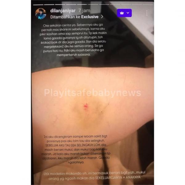 Luka Lebam Dilan Janiyar, diduga akibat KDRT yang dilakukan Safnoviar Tiasdi. (Foto: Instagram)