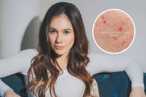 Jerawat Wulan Guritno. (Foto: Instagram)