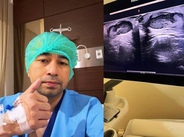 Ada benjolan di bahu Raffi Ahmad. (Foto: Instagram)