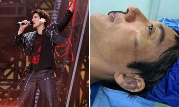 Mengerikan! Penyanyi Wang Leehom Jatuh saat Konser, Terima 39 Jahitan di Wajah