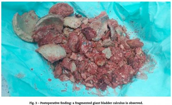 Viral Batu Kandung Kemih 2 Kg, Mengapa Kurang Minum dan Menahan Kencing Berakibat Fatal?