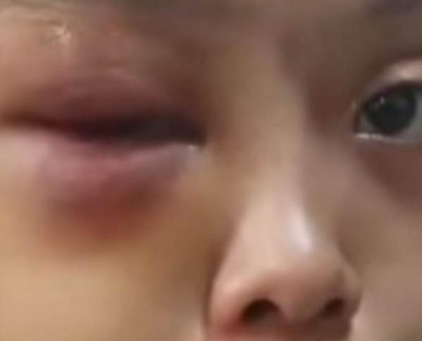 Kejam, Tante di Kampar Aniya Ponakan yang Yatim degan Rotan dan Dinjak Hanya Hal Sepele