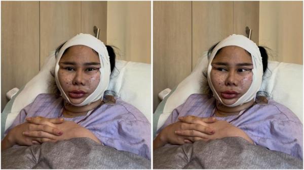 Viral! Wajah Denise Chariesta Bengkak Parah usai Operasi Plastik Rp1 Miliar