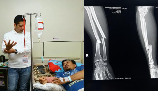 Aipda Heru Patah Tangan Saat Bubarkan Tawuran Geng Motor di Makassar
