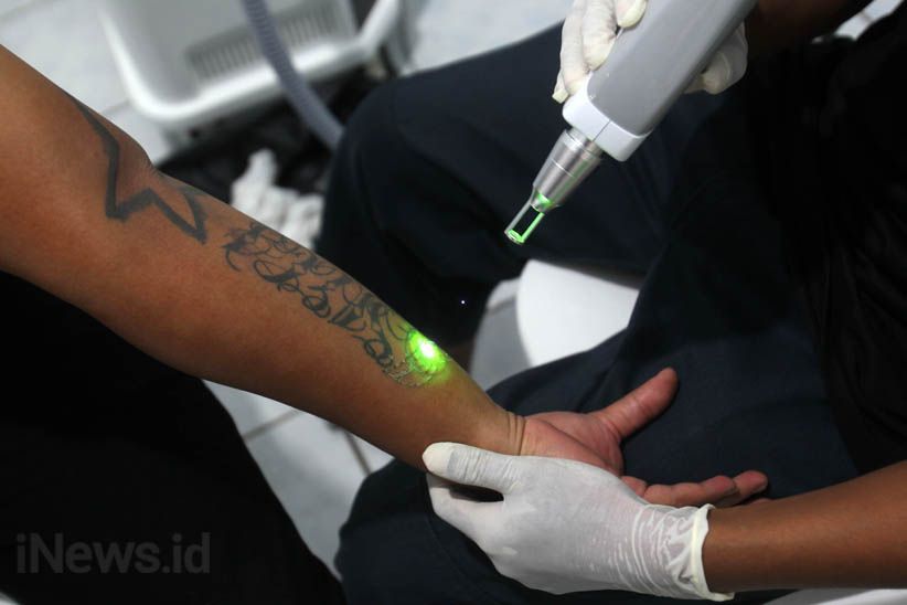 Melihat Proses Menghilangkan Tato di Badan - Bagian 12