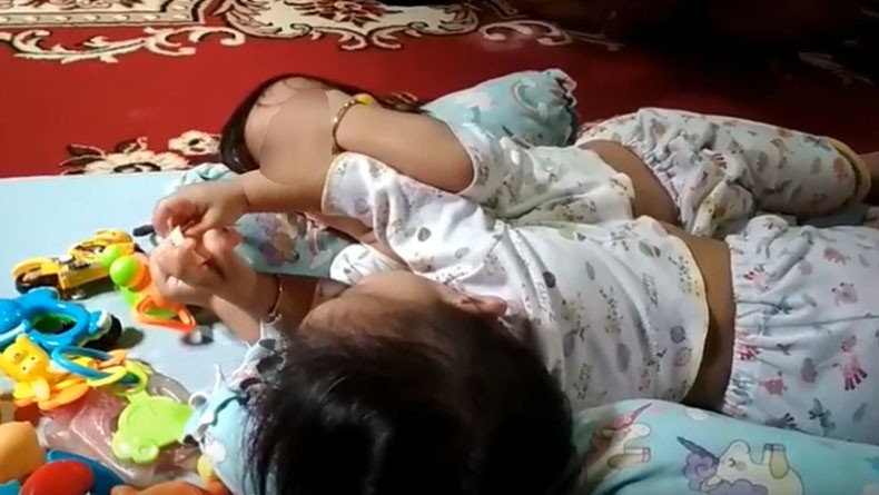 Orang Tua Bayi Kembar Siam Akila dan Azila Pasrah Jelang Operasi Pemisahan