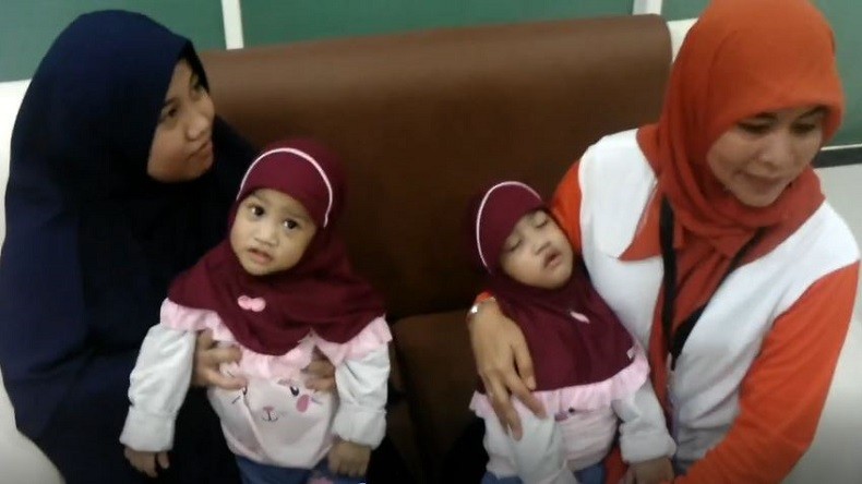 Bayi Kembar Siam Asal Kendari yang Berhasil Dipisahkan di Surabaya Sudah Boleh Pulang