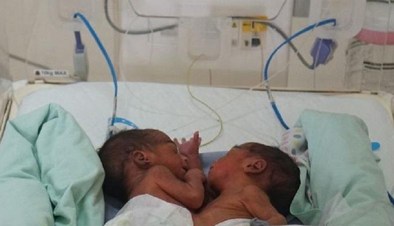 Bayi Kembar Siam di RSUP Adam Malik Sudah 2 Bulan, Operasi Pemisahan Belum Dijadwalkan