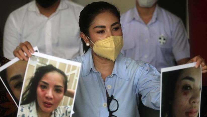 Ini Wajah Lebam Nindy Ayunda akibat KDRT, Ditunjukkan kepada Komnas Perempuan - Bagian 4