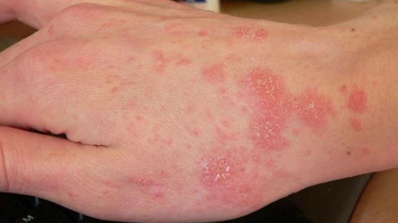 Puluhan Warga di Pontianak Diserang Gatal Scabies, Dinkes Gelar Pengobatan Massal