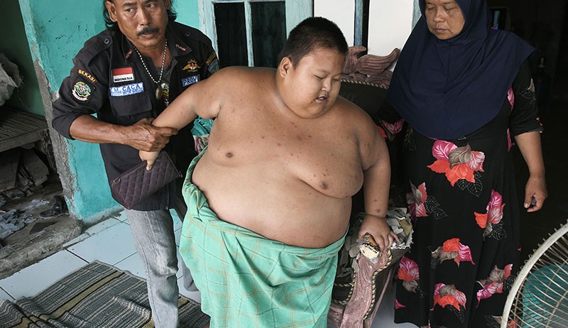 Potret Penderita Obesitas Asal Bekasi, Umur 11 Tahun Berat Badan 115 Kg - Bagian 1
