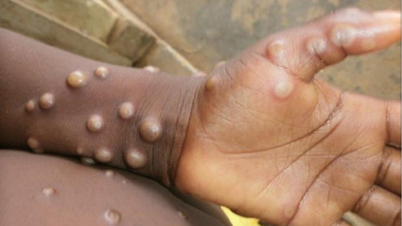 Heboh Warga Sumedang Terinfeksi Monkeypox, Dinkes Jabar Pastikan Cacar Biasa 